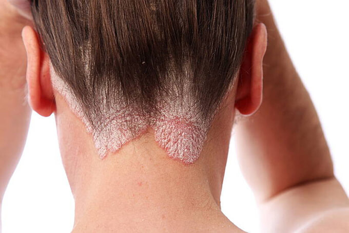 Pérdida de cabello por infección de hongos