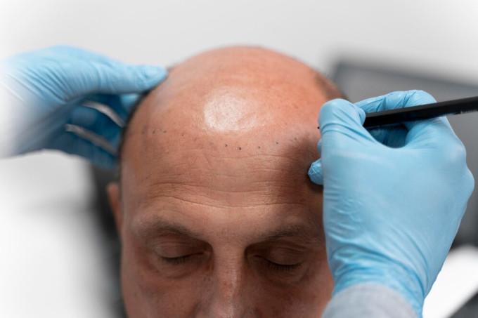 protesis capilar vs transplante de cabello