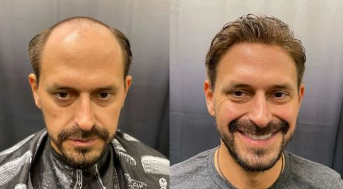 Protesis capilar cómoda de usar