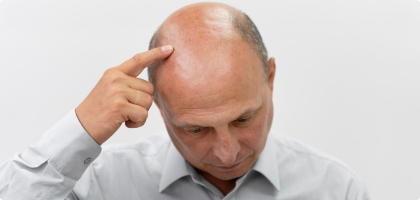 Tiroides y Pérdida de Cabello: Razones, Remedios y Más