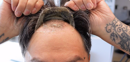 Cómo Remover una Prótesis Capilar de Manera Efectiva y Segura