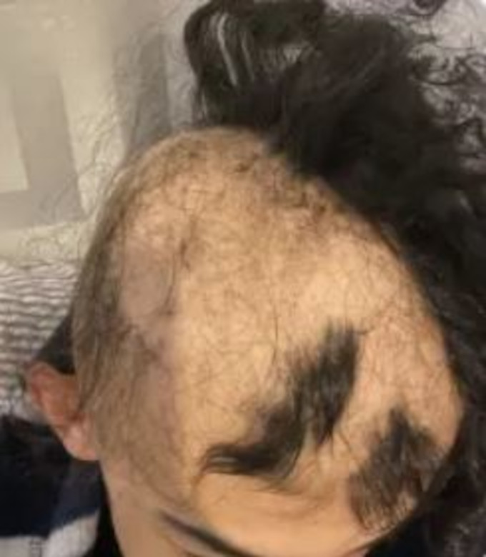 Pérdida de Cabello en Niños