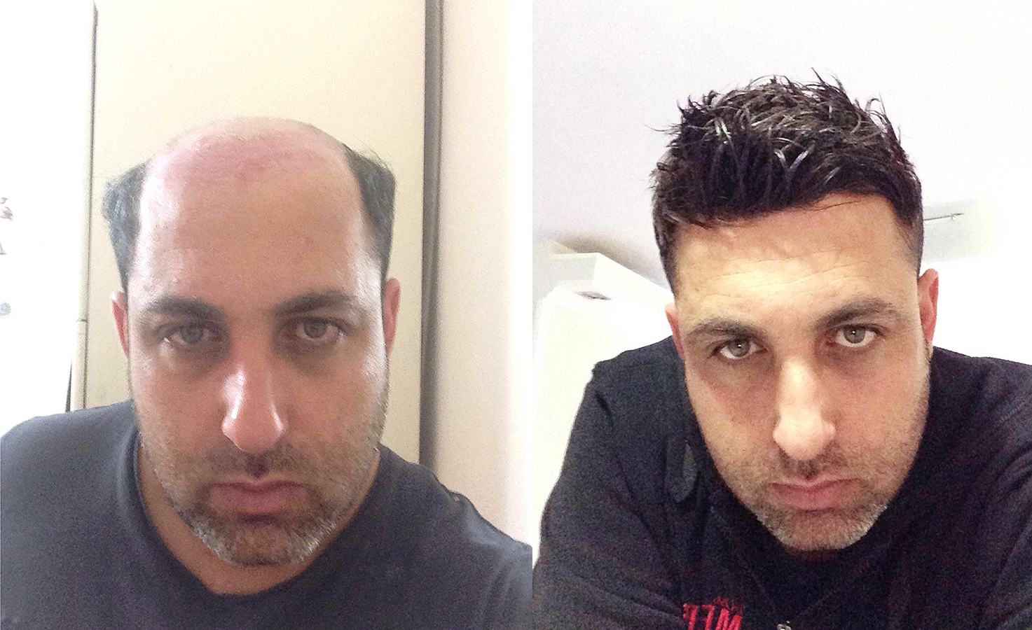 Hair replacement system customer photo
