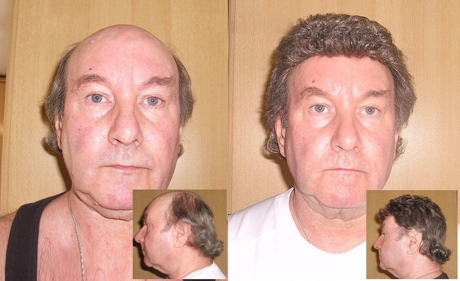 Non Surgical Hair Replacement System Photo