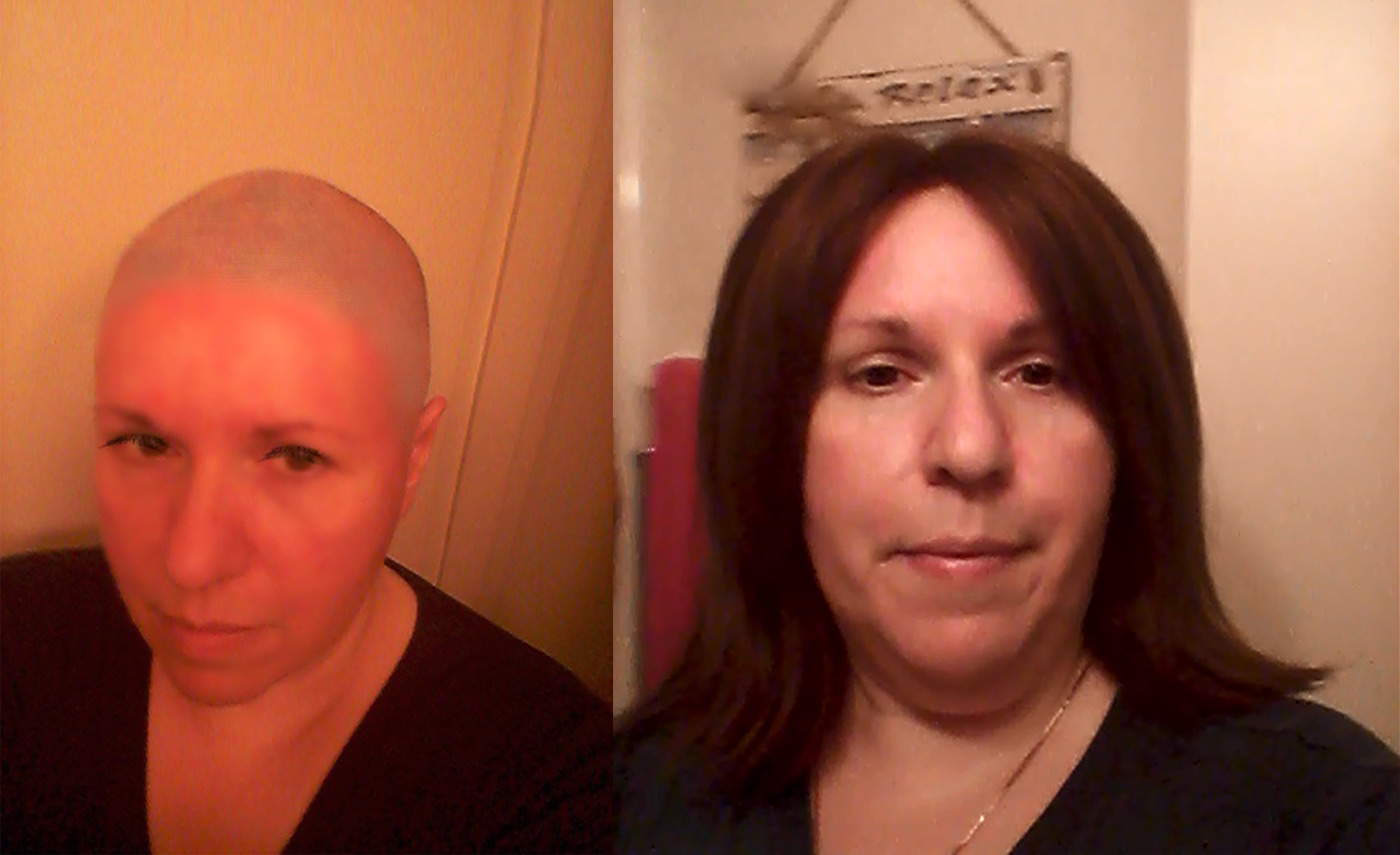 Female hair replacement before & after